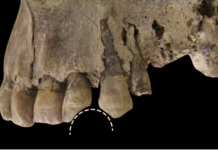 Des dents anciennes révèlent les origines glaciaires de la 4e drogue addictive la plus répandue au monde